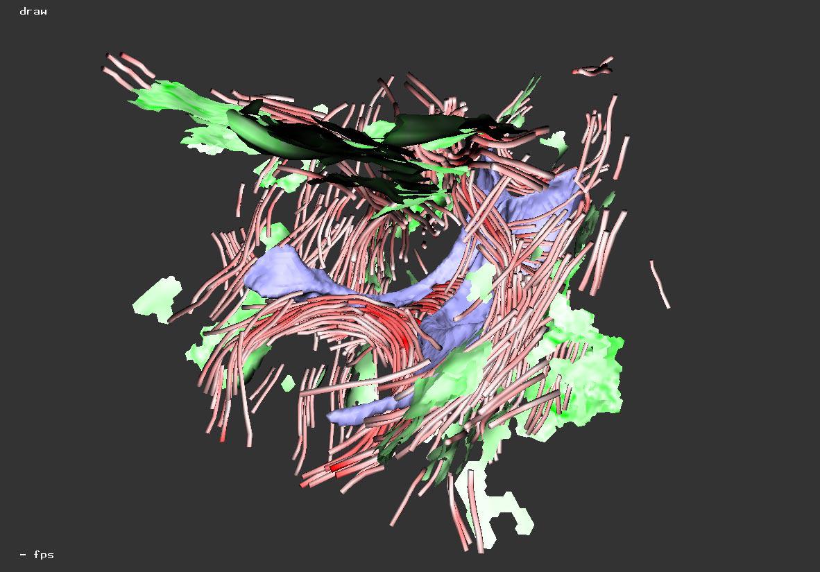An Immersive Virtual Environment for {DT-MRI} Volume Visualization Applications: a Case Study