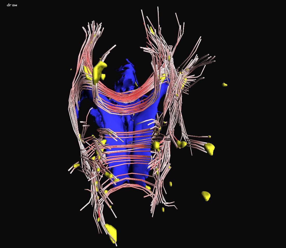 Visualization of the Interaction of Multiple Sclerosis lesions with adjacent white matter fibers using Streamtubes and Streamsurfaces
