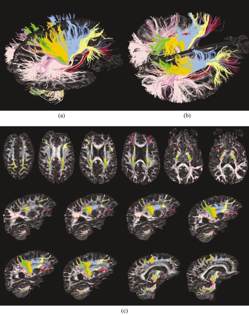 White Matter Tractography Using Diffusion Tensor Deflection