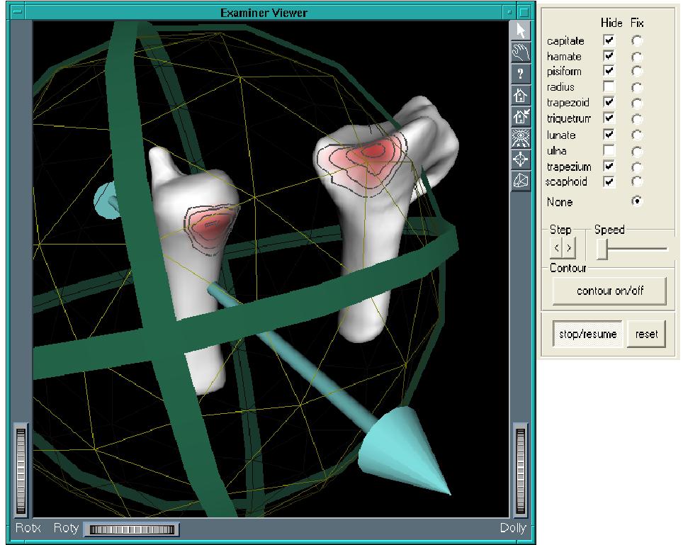 JointViewer an interactive system for exploring orthopedic data