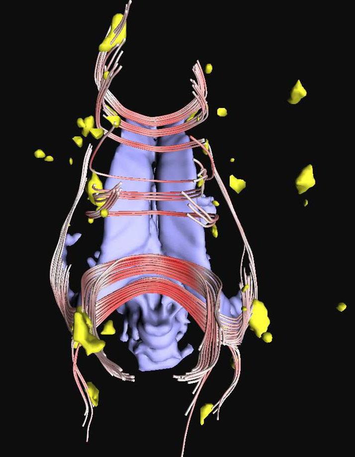 Strategy for Detecting Neuronal Fibers at Risk for Neurodegeneration In Earliest {MS} by Streamtube Tractography at {3T}