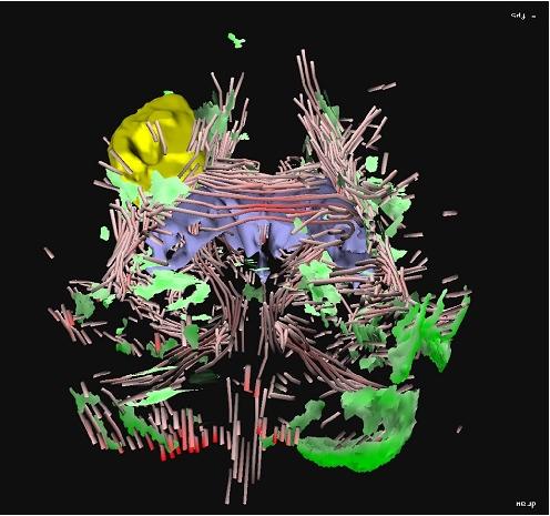 Application of {DTI} Visualization and Analysis on a Data Set from a Brain Tumor Patient